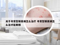 关于寻常型银屑病怎么治疗 寻常型银屑病怎么治才能断根