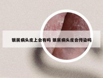 银屑病头皮上会有吗 银屑病头皮会传染吗