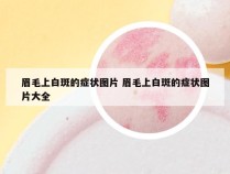 眉毛上白斑的症状图片 眉毛上白斑的症状图片大全