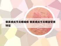 银屑病关节炎眼睛痒 银屑病关节炎眼部受累特征