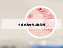 牛皮癣患者可以植发吗