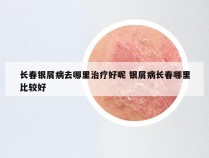 长春银屑病去哪里治疗好呢 银屑病长春哪里比较好