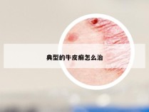 典型的牛皮癣怎么治