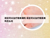 绿豆可以治疗银屑病吗 绿豆可以治疗银屑病吗怎么吃