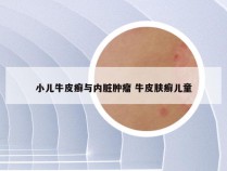 小儿牛皮癣与内脏肿瘤 牛皮肤癣儿童