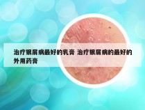 治疗银屑病最好的乳膏 治疗银屑病的最好的外用药膏
