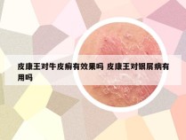 皮康王对牛皮癣有效果吗 皮康王对银屑病有用吗