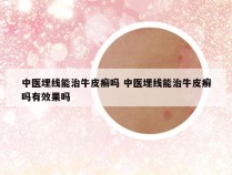 中医埋线能治牛皮癣吗 中医埋线能治牛皮癣吗有效果吗