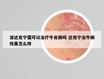 涂达克宁霜可以治疗牛皮癣吗 达克宁治牛癣效果怎么样