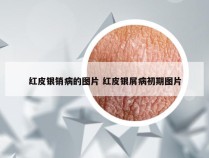 红皮银销病的图片 红皮银屑病初期图片