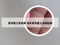 夏天腿上有皮癣 每年夏天腿上皮肤起癣