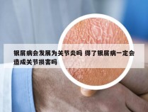 银屑病会发展为关节炎吗 得了银屑病一定会造成关节损害吗