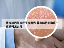 黄皮肤药能治疗牛皮癣吗 黄皮肤药能治疗牛皮癣吗怎么用