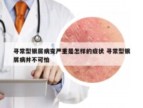 寻常型银屑病变严重是怎样的症状 寻常型银屑病并不可怕