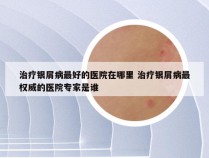 治疗银屑病最好的医院在哪里 治疗银屑病最权威的医院专家是谁