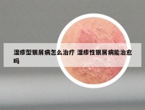 湿疹型银屑病怎么治疗 湿疹性银屑病能治愈吗