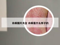 白癣图片大全 白癣是什么样子的
