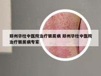 郑州华柱中医院治疗银屑病 郑州华柱中医院治疗银屑病专家