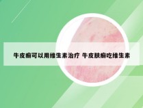 牛皮癣可以用维生素治疗 牛皮肤癣吃维生素