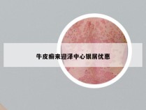牛皮癣来迎泽中心银屑优惠