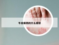 牛皮癣初的什么症状