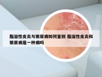 脂溢性皮炎与银屑病如何鉴别 脂溢性皮炎和银屑病是一种病吗