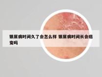 银屑病时间久了会怎么样 银屑病时间长会癌变吗