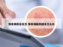 银屑病抓后会怎 银屑病越抓越多怎么办