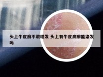 头上牛皮癣不敢理发 头上有牛皮病癣能染发吗