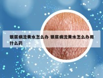 银屑病流黄水怎么办 银屑病流黄水怎么办用什么药