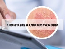 3月婴儿银屑病 婴儿银屑病图片及症状图片