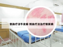 刺血疗法牛皮癣 刺血疗法治疗银屑病