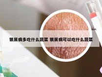 银屑病多吃什么蔬菜 银屑病可以吃什么蔬菜