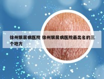 徐州银屑病医院 徐州银屑病医院最出名的三个地方