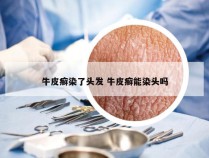 牛皮癣染了头发 牛皮癣能染头吗