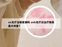 uv光疗治银屑病吗 uvb光疗仪治疗银屑最大剂量?