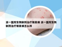 浙一医院生物制剂治疗银屑病 浙一医院生物制剂治疗银屑病怎么样