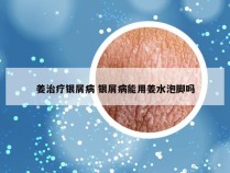 姜治疗银屑病 银屑病能用姜水泡脚吗