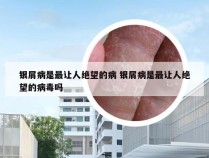 银屑病是最让人绝望的病 银屑病是最让人绝望的病毒吗