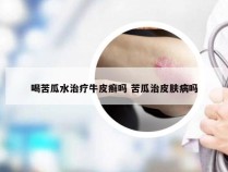 喝苦瓜水治疗牛皮癣吗 苦瓜治皮肤病吗