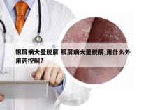 银屑病大量脱屑 银屑病大量脱屑,用什么外用药控制?
