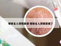 哪些名人得银屑病 哪些名人得银屑病了
