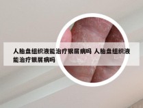 人胎盘组织液能治疗银屑病吗 人胎盘组织液能治疗银屑病吗