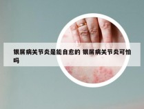 银屑病关节炎是能自愈的 银屑病关节炎可怕吗
