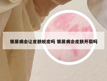 银屑病会让皮肤蜕皮吗 银屑病会皮肤开裂吗