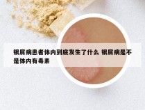 银屑病患者体内到底发生了什么 银屑病是不是体内有毒素