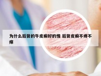 为什么后背的牛皮癣好的慢 后背皮癣不疼不痒