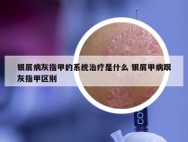 银屑病灰指甲的系统治疗是什么 银屑甲病跟灰指甲区别