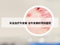 长治治疗牛皮癣 治牛皮癣的专科医院