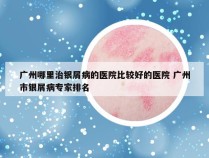 广州哪里治银屑病的医院比较好的医院 广州市银屑病专家排名